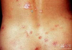 梅毒吃瓜,吃瓜群众如何看这场健康危机