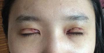 割完双眼皮可以吃凉瓜吗,凉瓜可否食用？